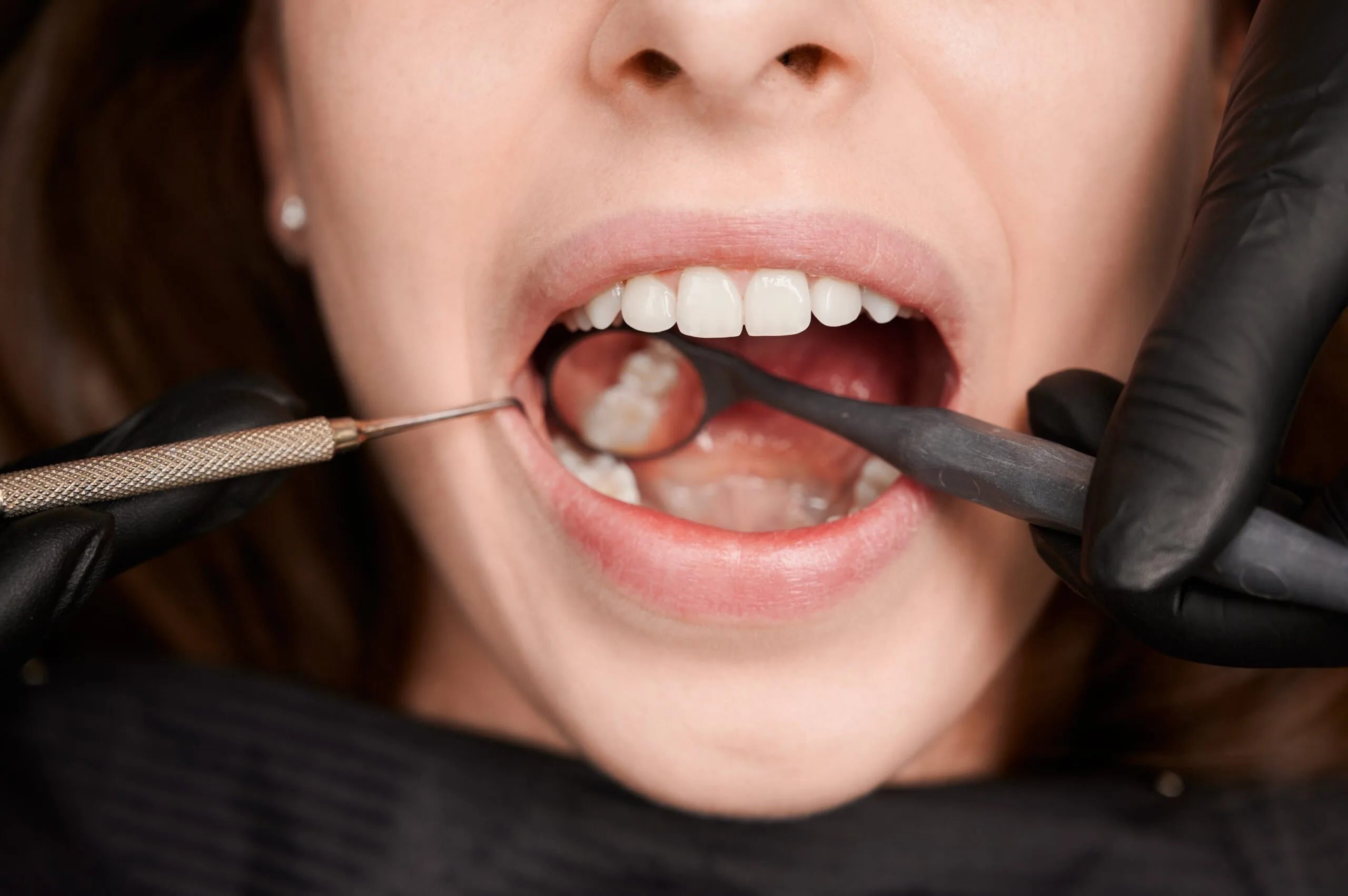 Root Canal Therapy